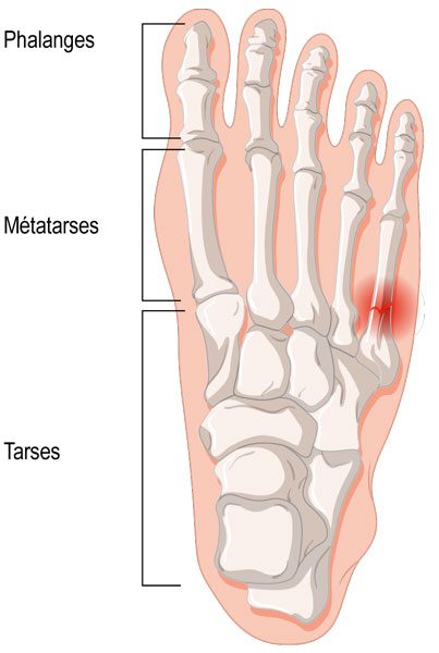 fractures de fatigue ou de stress