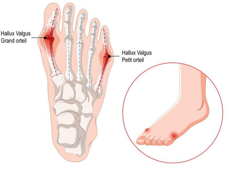 hallux valgus illustration orthopedie