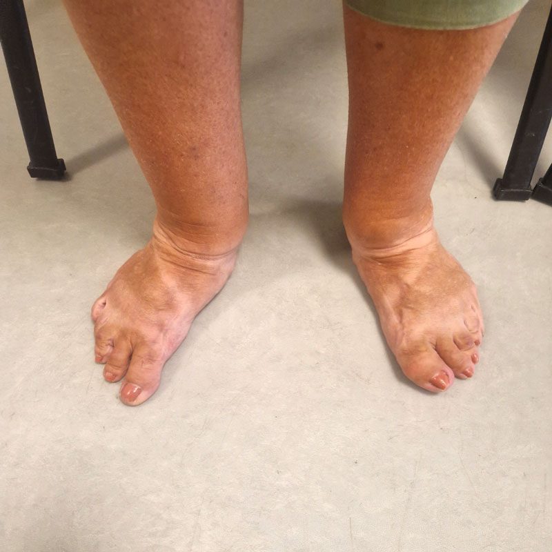 pied plat adulte consultation orthopedie chauveau