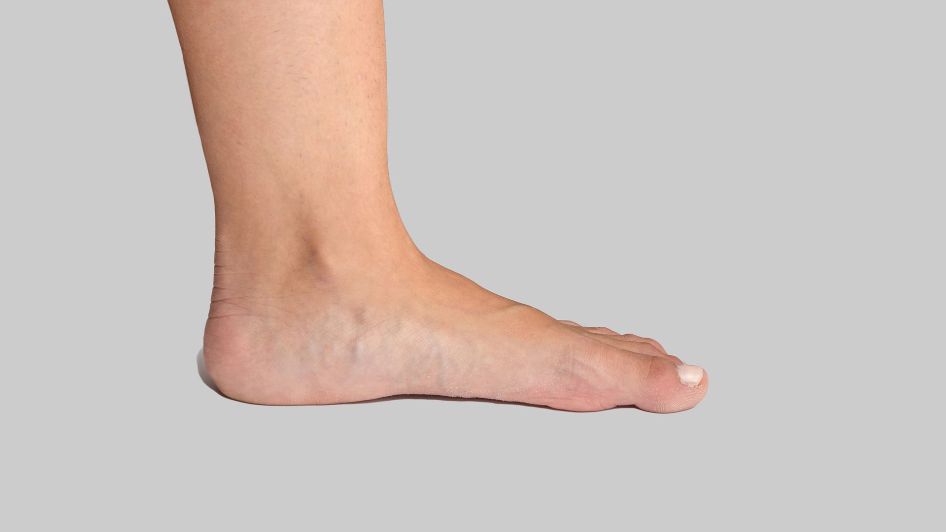 pied plat adulte femme voute plantaire manquante orthopedie chauveau